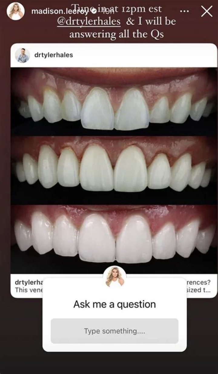 
Madison LeCroy Teeth Before: Has She Used Braces And Whitening 