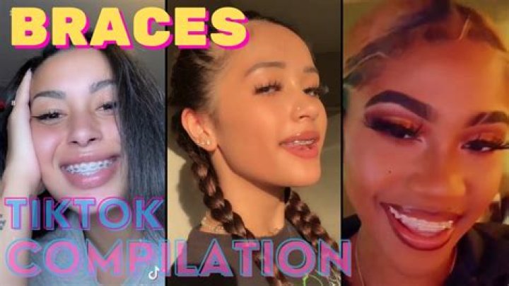 
Who Is Braces Girl on TikTok? Leaked Video Viral 